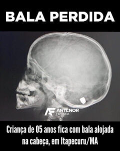 Criança de 05 anos fica com bala alojada na cabeça, em Itapecuru/MA