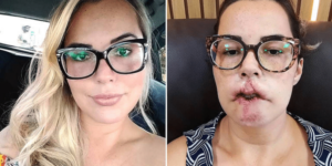 O quê achou??? Influenciadora fica sem os lábios após harmonização facial