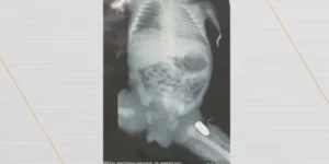 Adolescente grávida é alvejada e entra em trabalho de parto; bebê é atingido na perna