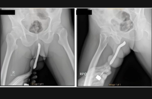 Loucura!!! Homem Passa Por Cirurgia Após Escova De Dente Que Enfiou No Pênis Quebrar Durante O Sexo