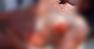 Após discussão, mulher espera marido dormir e joga caldeirão de água quente nele