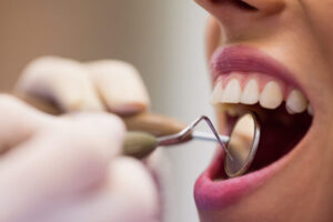 Cinco dicas para evitar perda de dentes e manter o sorriso saudável e bonito