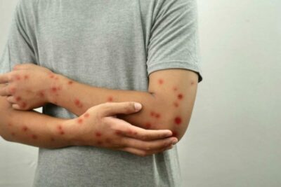 Maranhão tem 25 casos suspeitos de Mpox; saiba as cidades onde as ocorrências foram noticiadas
