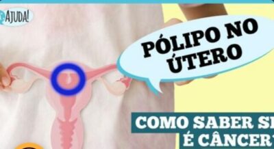 O que são pólipos uterino e quais os sintomas?
