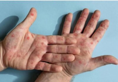 Estado de SP registra 315 casos de mpox nos primeiros 7 meses de 2024